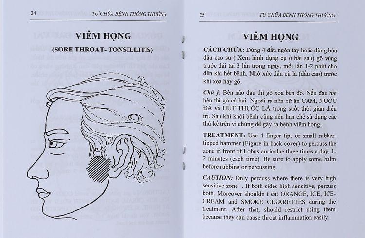 Viêm họng